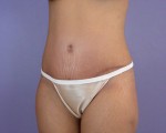 Tummy Tuck