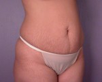 Tummy Tuck Before and after photo