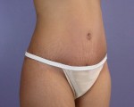 Tummy Tuck Before and after photo