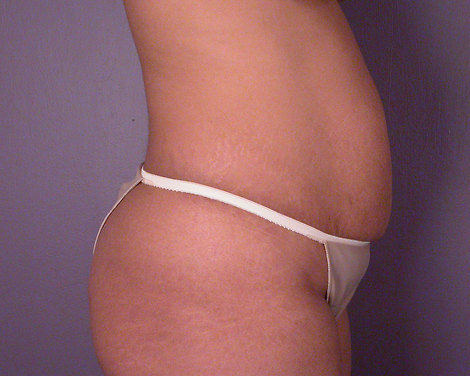 Tummy Tuck before and after photo