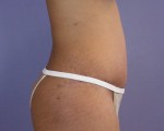 Tummy Tuck Before and after photo