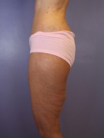 Tummy Tuck Before and after photo