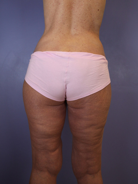 Tummy Tuck before and after photo