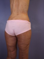 Tummy Tuck Before and after photo