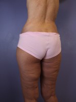 Tummy Tuck Before and after photo