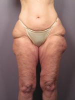 Tummy Tuck Before and after photo