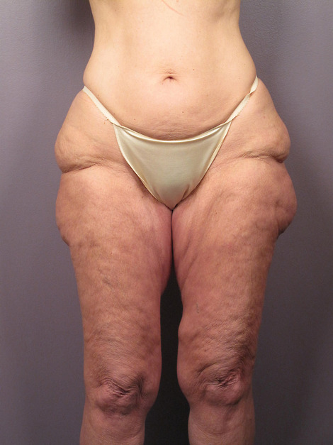 Tummy Tuck before and after photo