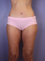 Tummy Tuck Before and after photo