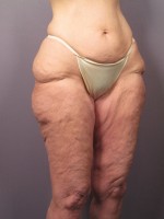 Tummy Tuck Before and after photo