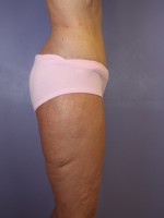 Tummy Tuck Before and after photo