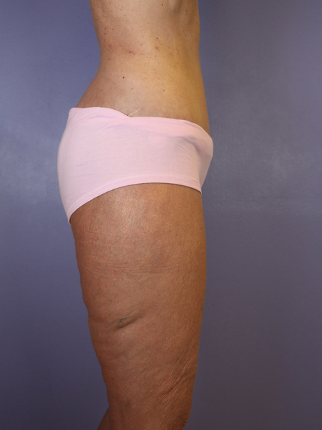 Tummy Tuck before and after photo