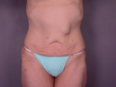 Tummy Tuck before and after photo