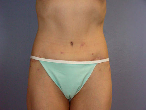 Tummy Tuck before and after photo