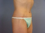 Tummy Tuck Before and after photo