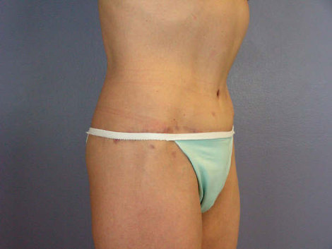 Tummy Tuck before and after photo