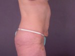 Tummy Tuck Before and after photo