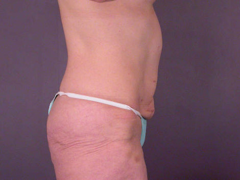 Tummy Tuck before and after photo