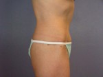 Tummy Tuck Before and after photo