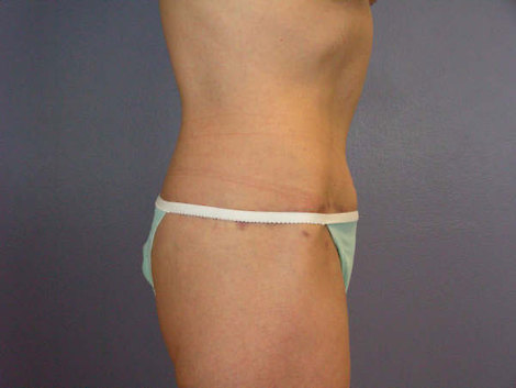 Tummy Tuck before and after photo