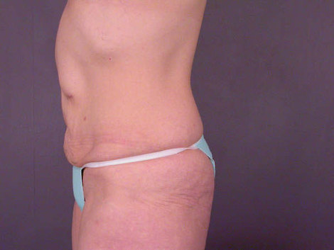 Tummy Tuck before and after photo