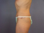 Tummy Tuck Before and after photo