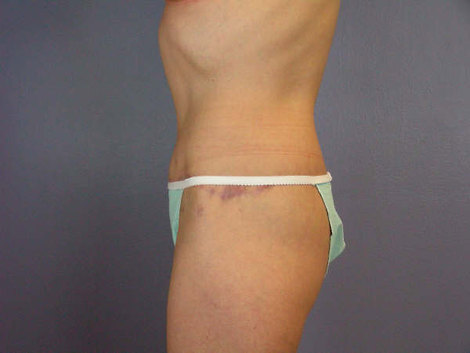 Tummy Tuck before and after photo