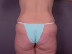 Tummy Tuck Before and after photo