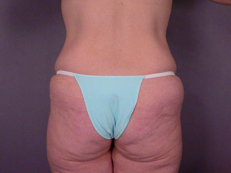 Tummy Tuck before and after photo