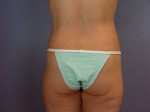 Tummy Tuck Before and after photo