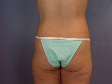 Tummy Tuck before and after photo