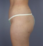 Tummy Tuck Before and after photo