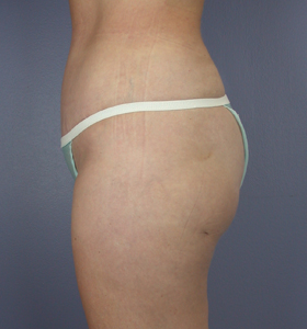 Tummy Tuck before and after photo