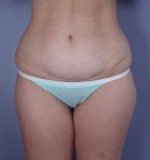 Tummy Tuck Before and after photo