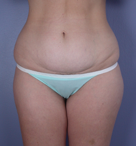 Tummy Tuck before and after photo