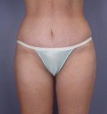 Tummy Tuck Before and after photo