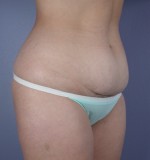 Tummy Tuck Before and after photo