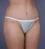 Tummy Tuck Before and after photo