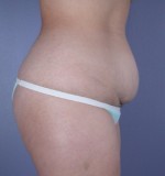 Tummy Tuck Before and after photo