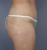 Tummy Tuck Before and after photo