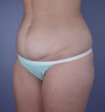 Tummy Tuck Before and after photo