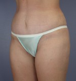 Tummy Tuck Before and after photo