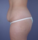 Tummy Tuck Before and after photo