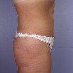 Tummy Tuck