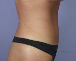 Tummy Tuck Before and after photo