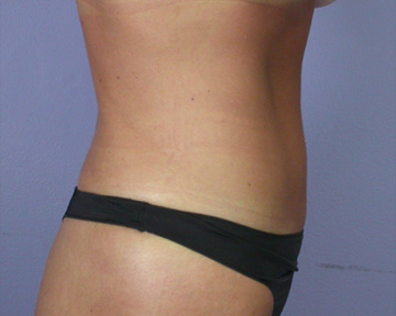 Tummy Tuck before and after photo