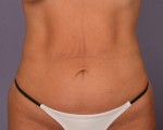 Tummy Tuck Before and after photo