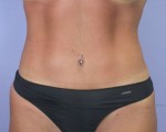 Tummy Tuck Before and after photo