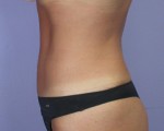 Tummy Tuck Before and after photo