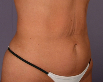 Tummy Tuck before and after photo