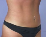 Tummy Tuck Before and after photo